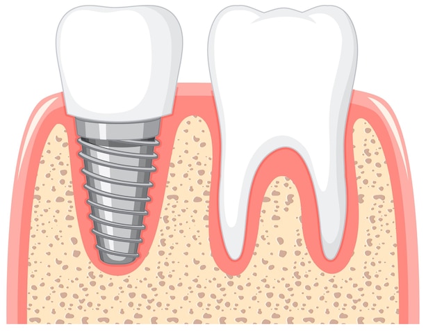 Bezpłatny wektor zdrowy ząb i implant dentystyczny w dziąśle na białym tle