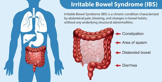 Bezpłatny wektor zespół jelita drażliwego ibs infografika