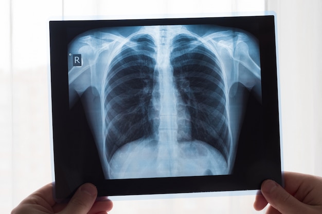 Koncepcja radiografii płuc. lekarz radiologii badający film rtg klatki piersiowej pacjenta z rakiem płuc lub zapaleniem płuc.