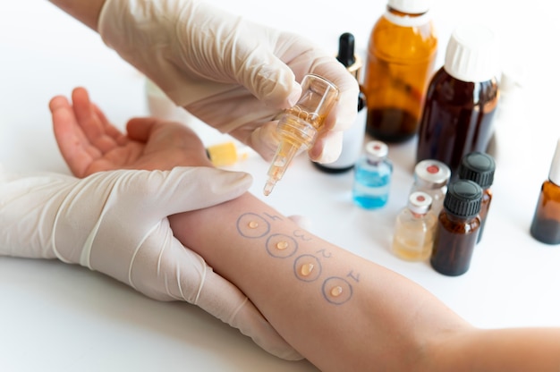 Test reakcji alergicznej skóry na ramieniu osoby