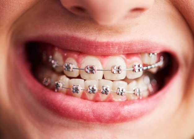 Bezpłatne zdjęcie ujęcie zębów dziecka z aparatem ortodontycznym