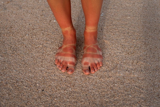 Widok poparzonych słońcem stóp kobiety od noszenia sandałów na plaży