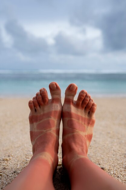 Widok poparzonych słońcem stóp kobiety od noszenia sandałów na plaży