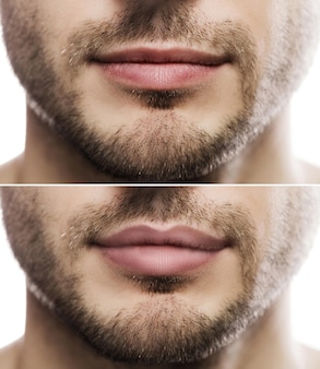 Wynik powiększania ust. męskie usta przed i po wstrzyknięciu wypełniacza.