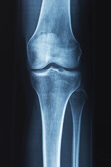 Zdjęcie rentgenowskie ludzkiego kolana. problemy z kością lub stawem.