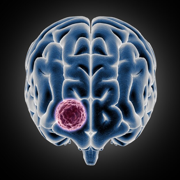 3D médico mostrando cerebro con tumor creciendo