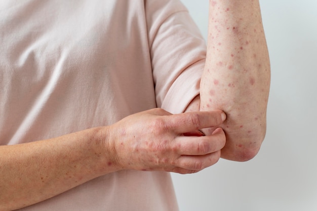 Alergia cutánea en el brazo de una persona.