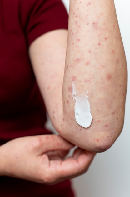 Alergia cutánea en el brazo de una persona.