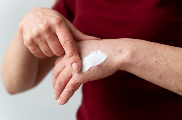 Alergia cutánea en el brazo de una persona.