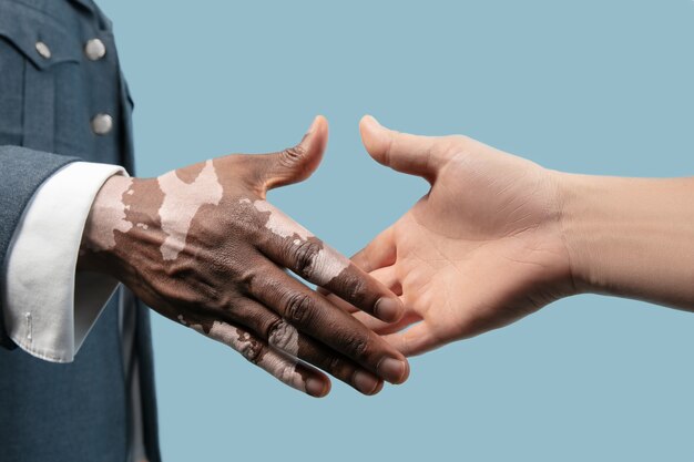 Cerca de manos masculinas con pigmentos de vitiligo aislado sobre fondo azul.
