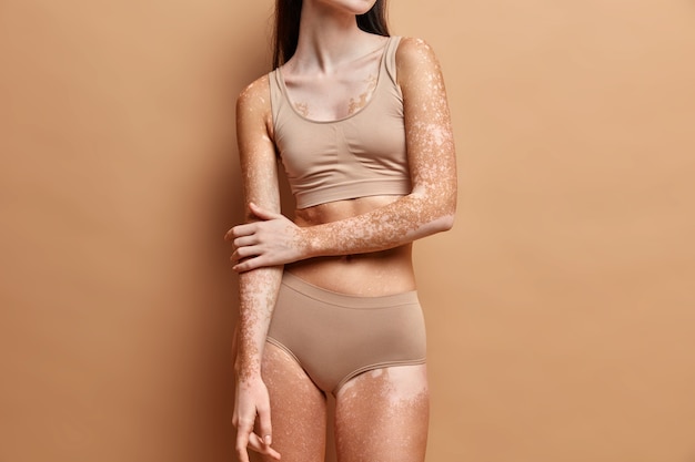 Cerrar en mujer delgada con piel de vitiligo