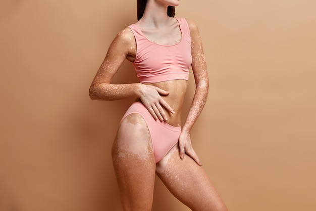Cerrar en mujer delgada con piel de vitiligo