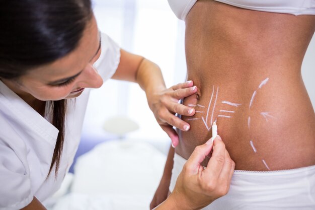 Cirujano dibujando líneas en el abdomen de la mujer para la liposucción y la eliminación de la celulitis
