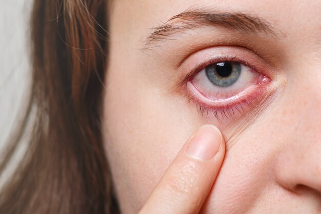 Concepto de medicina, cuidado de la salud y vista. La hembra irreconocible muestra su ojo rojo inflado con capilar de sangre