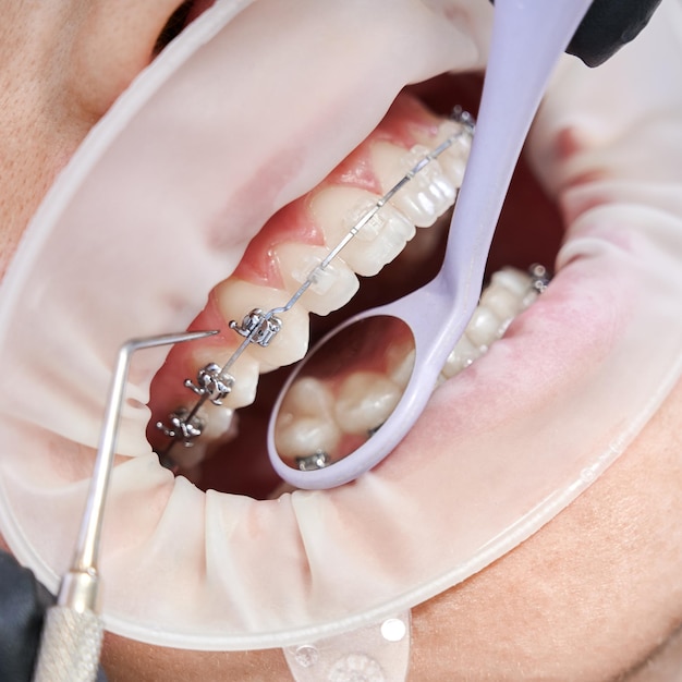 Dentista colocando frenos metálicos en los dientes del paciente