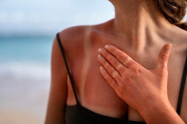 Detalles de la piel quemada por el sol de una mujer del sol de la playa