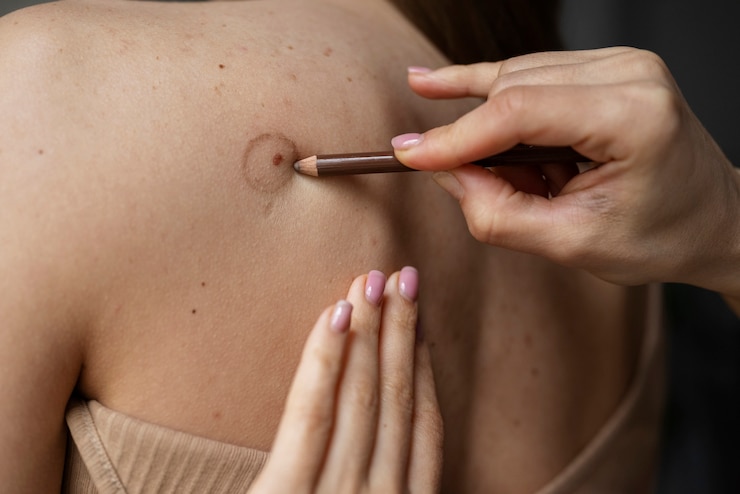 Foto gratuito doctora diagnosticando un melanoma en el cuerpo de una paciente