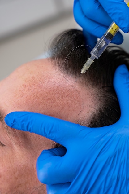 Hombre recibiendo un tratamiento para la caída del cabello