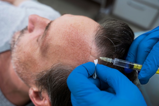 Hombre recibiendo un tratamiento para la caída del cabello