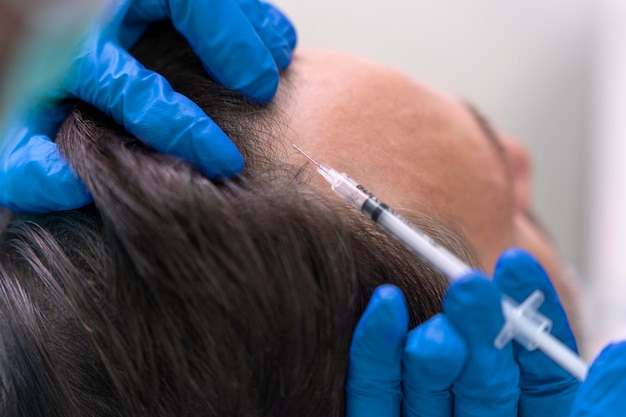 Hombre recibiendo un tratamiento para la caída del cabello