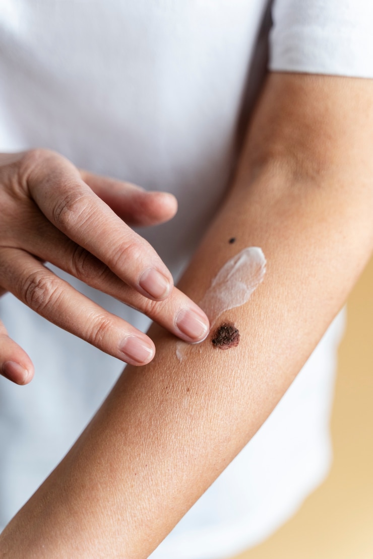 Foto gratuito mano de ángulo alto aplicando crema en el brazo