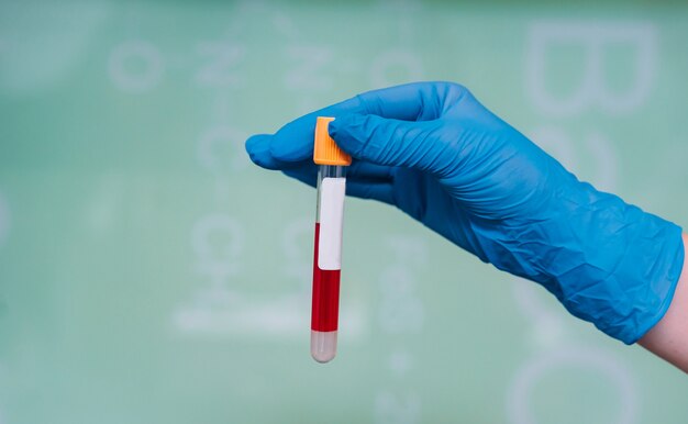 Una mano con guantes de goma sostiene un tubo de ensayo con el medicamento.