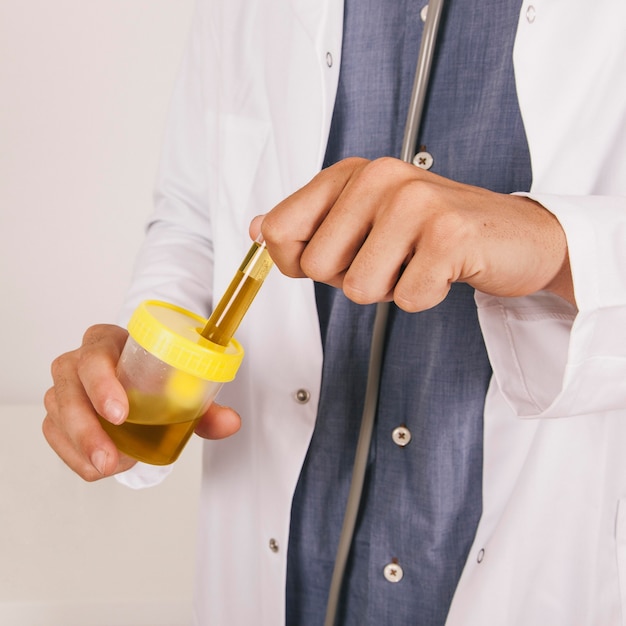Manos del doctor sujetando una muestra de orina