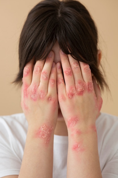 Foto gratuita manos del paciente que sufre de psoriasis