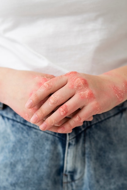 Manos del paciente que sufre de psoriasis