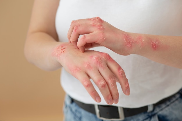 Manos del paciente que sufre de psoriasis