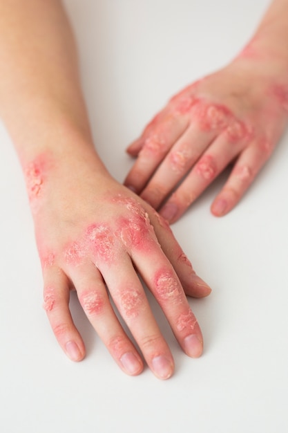 Foto gratuita manos del paciente que sufre de psoriasis