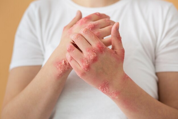 Manos del paciente que sufre de psoriasis