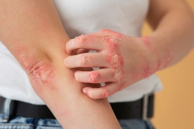 Manos del paciente que sufre de psoriasis