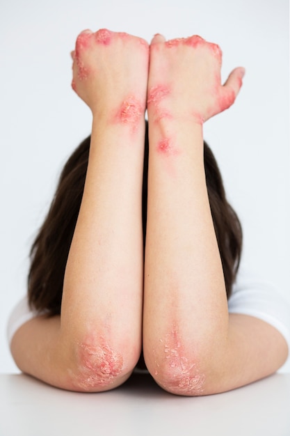 Manos del paciente que sufre de psoriasis