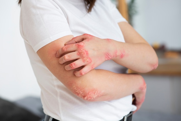 Foto gratuita manos del paciente que sufre de psoriasis