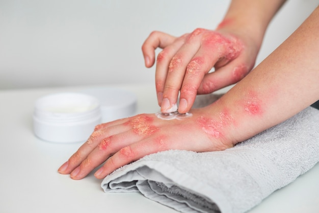 Foto gratuita manos del paciente que sufre de psoriasis