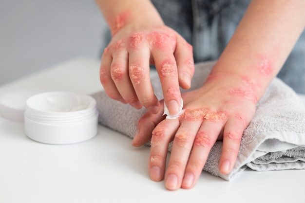 Manos del paciente que sufre de psoriasis