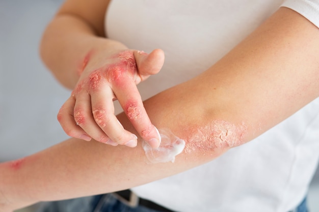 Manos del paciente que sufre de psoriasis