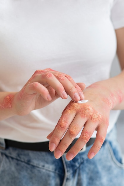 Manos del paciente que sufre de psoriasis