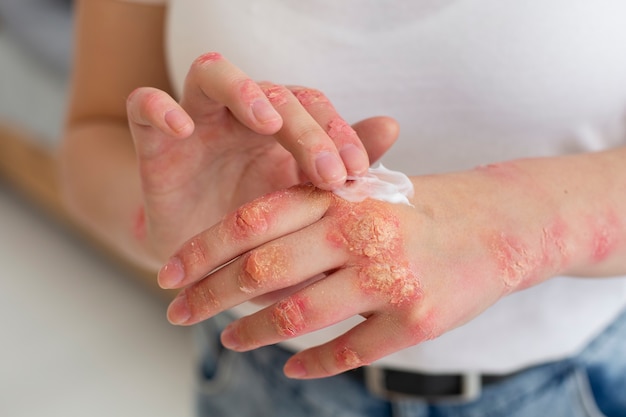 Manos del paciente que sufre de psoriasis