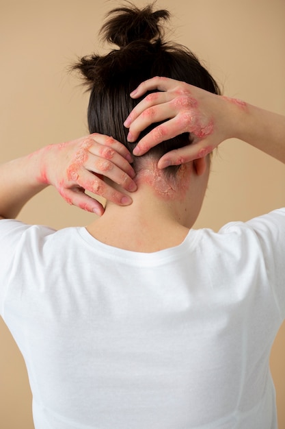 Foto gratuita manos del paciente que sufre de psoriasis