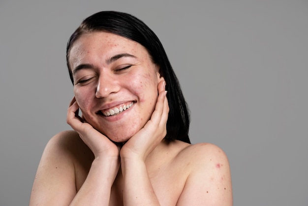 Mujer joven mostrando su acné con confianza