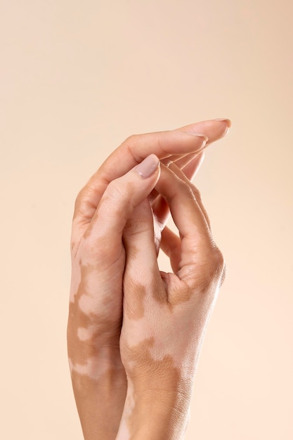 Mujer joven mostrando sus partes de la piel de vitiligo