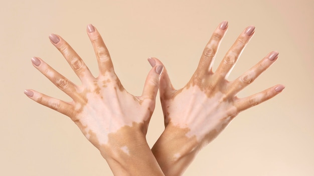 Mujer joven mostrando sus partes de la piel de vitiligo