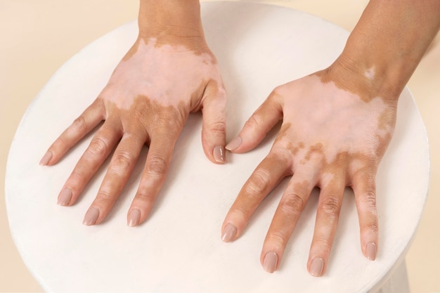 Mujer joven mostrando sus partes de la piel de vitiligo