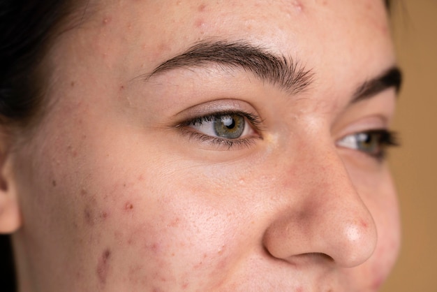 Mujer joven segura con primer plano de acné