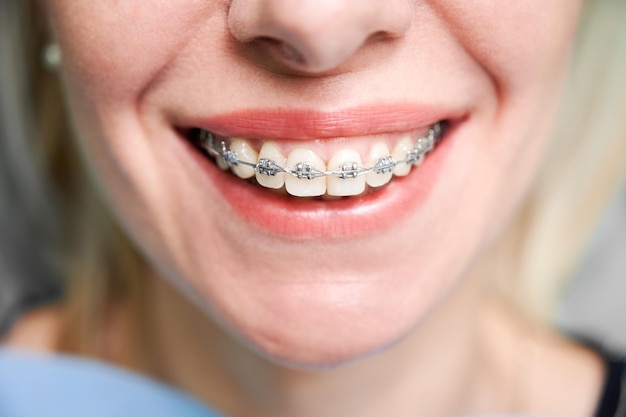 Mujer joven sonriente con frenos en los dientes