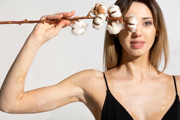 Foto gratuita mujer joven única con piel de vitiligo