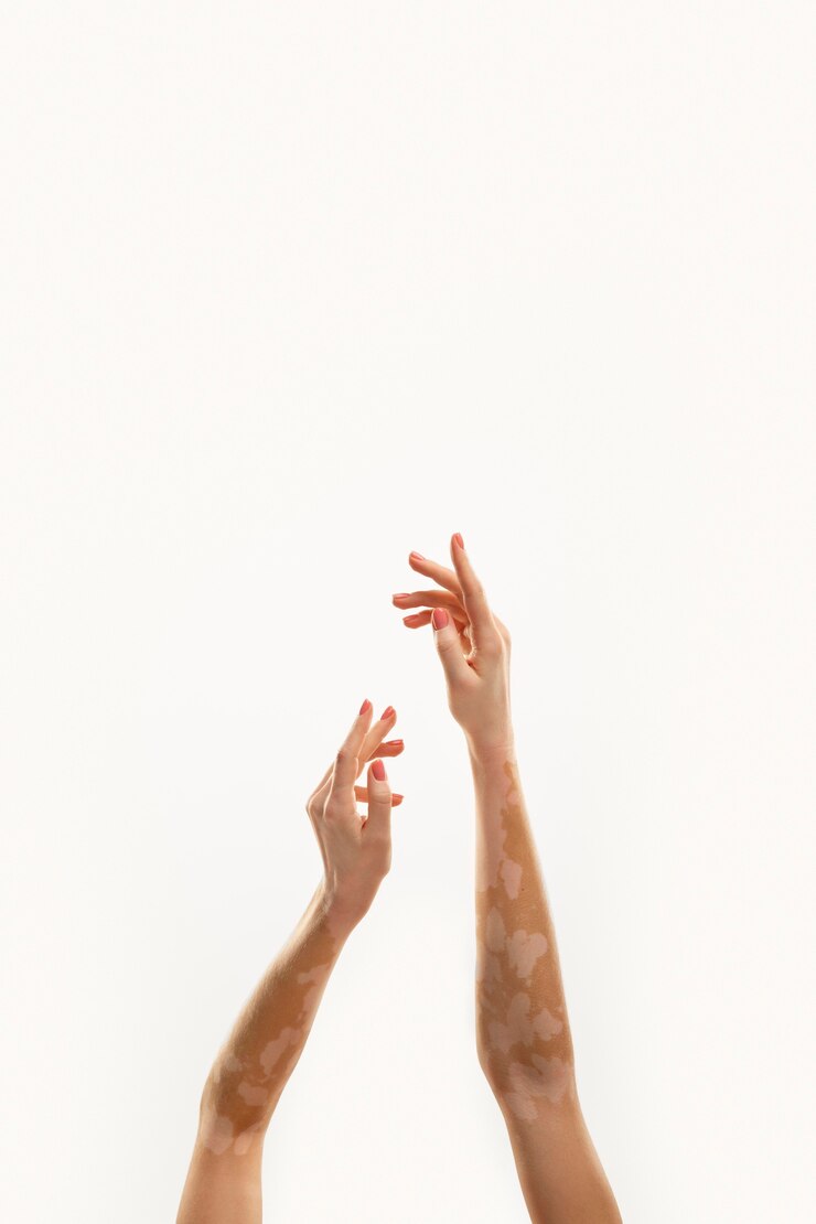 Foto gratuito mujer joven, con, vitiligo, manos