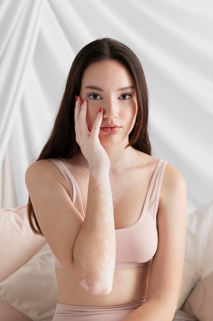 Foto gratuita mujer morena con vitiligo posando